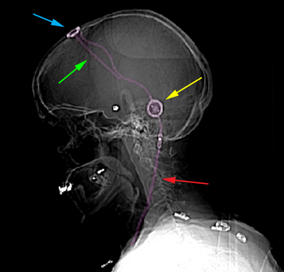 Hydrocephalus4mod
