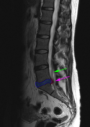 LumbarHernia3rev