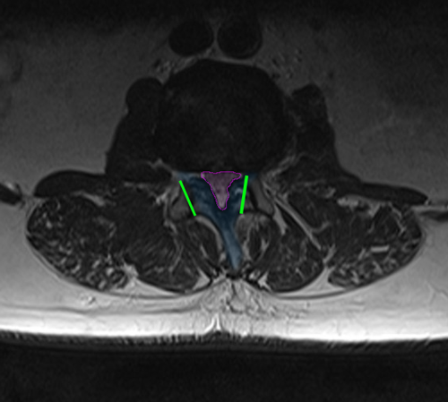 LumbarLaminectomy