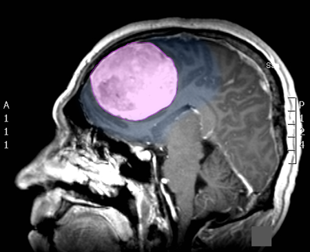 Meningioma5