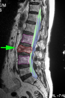 SpinalFracture3