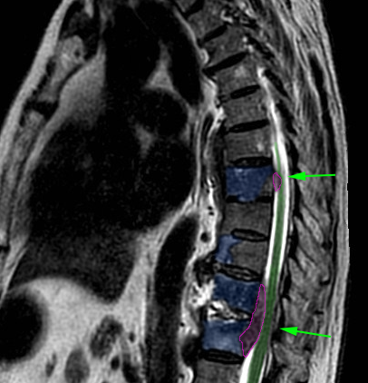 SpinalTumors